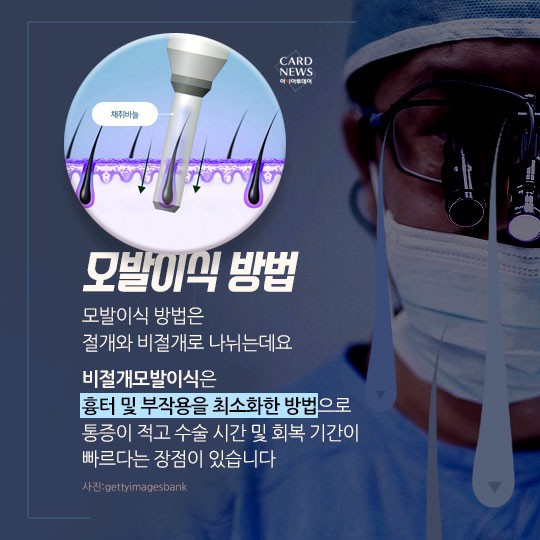 [카드뉴스] “소중한 머리카락 왜 자꾸 빠질까?”... 탈모 원인 및 치료법? 