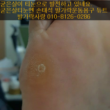티눈엔 발가락 운동용구 듀트