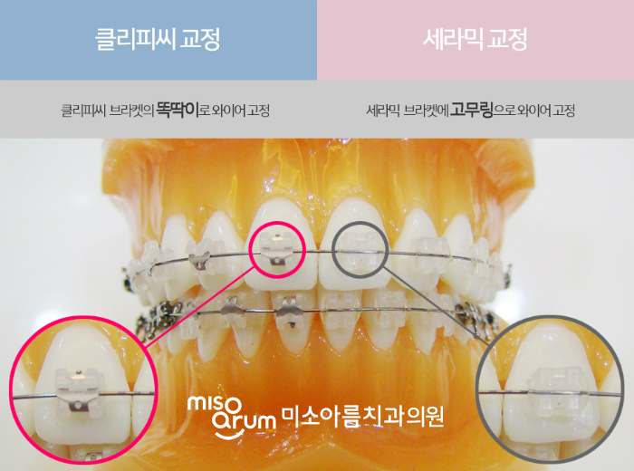 전주교정치과 치아교정 중 주의할 음식 #미소아름치과교정과